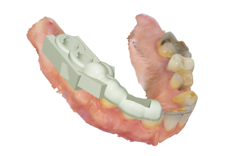 Surgical guides Technology